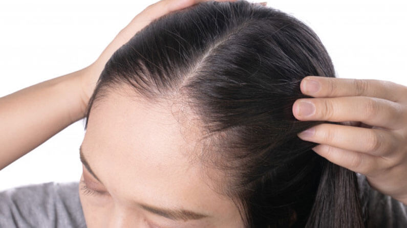 Women Hair Loss Wide Parting